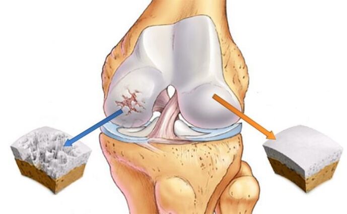 Qu'est-ce que l'arthrose