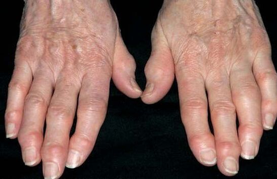 Arthrite des mains