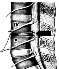 Image x-ray du département de l'ostéochondrose lombaire